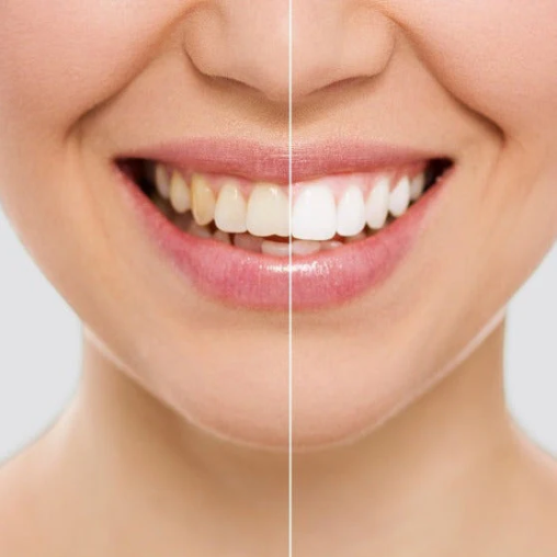 Combo Blanqueador DENTAL 2 EN 1! Con Formula mejorada